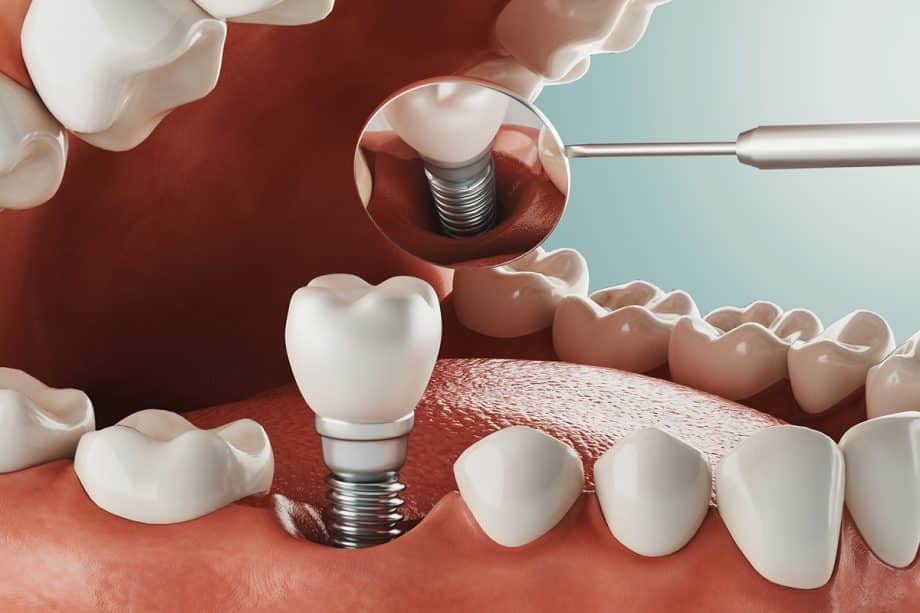 Am I A Candidate for Dental Implants? | Golia Dental