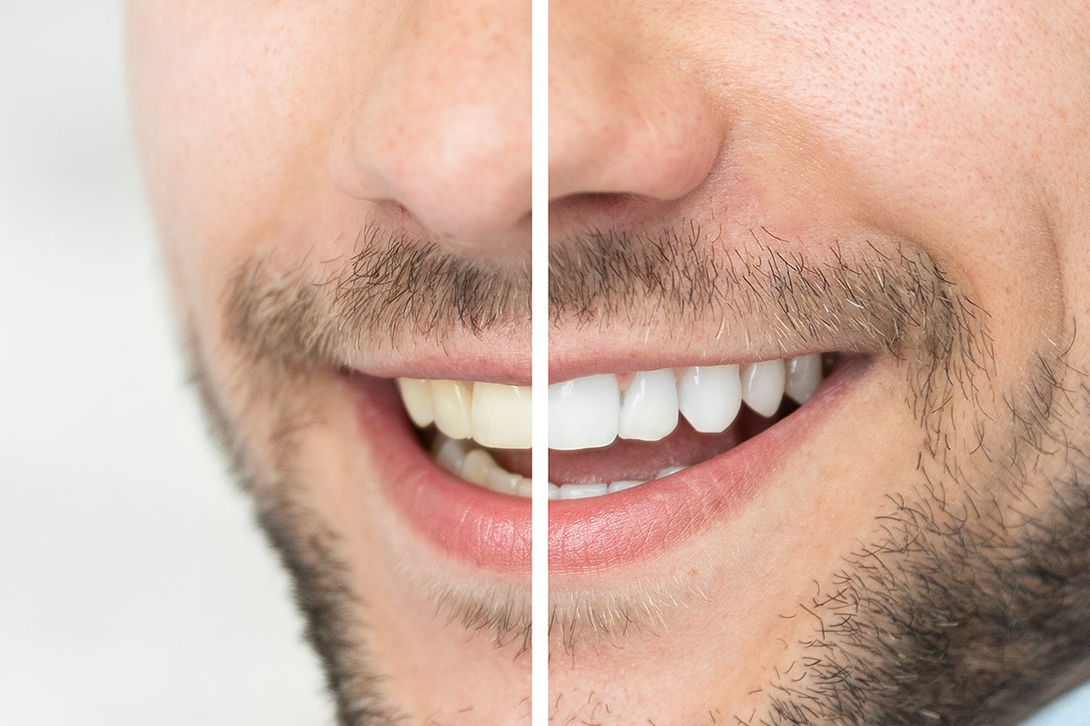 Do Teeth Whitening Strips Work BlogTheDay