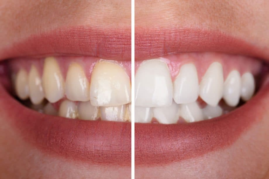 before and after image of teeth whitening